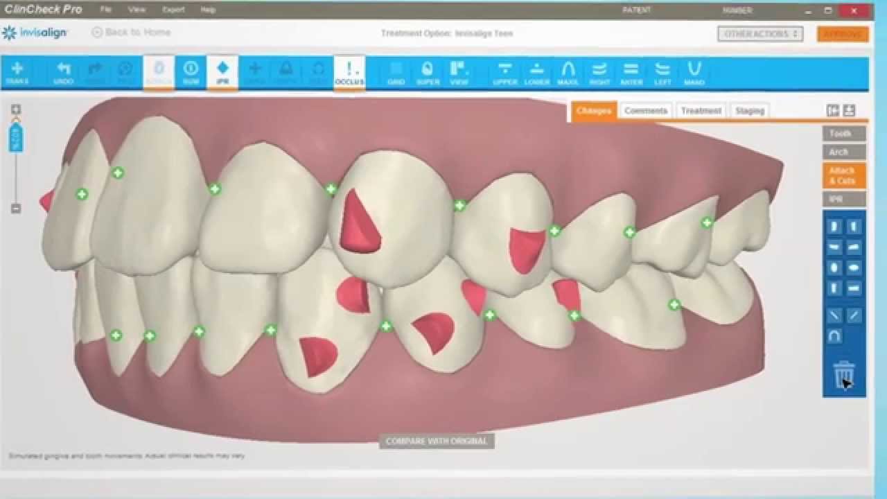 ClinCheck, el simulador virtual de los movimientos de los dientes